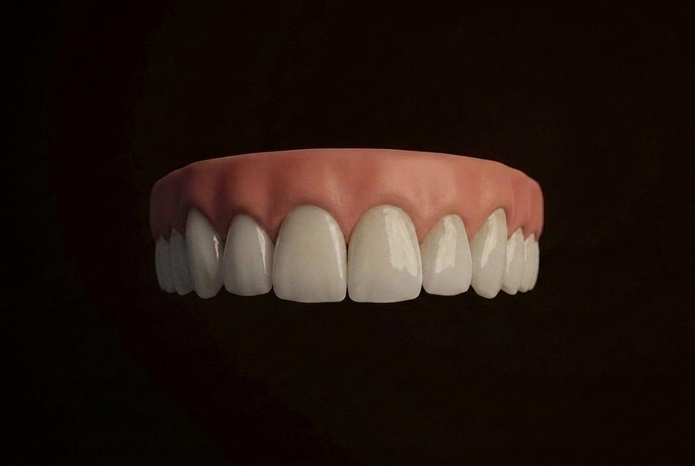 Conceptual simulation of veneers